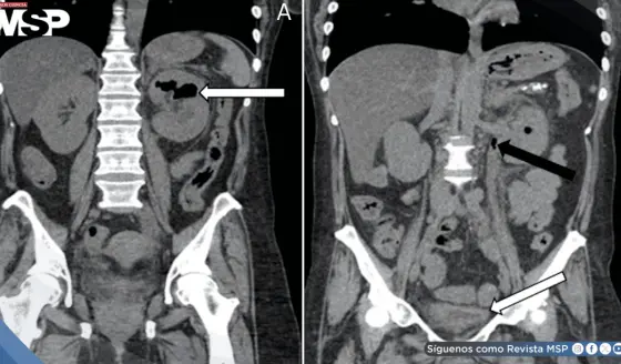 Pielitis enfisematosa fulminante en paciente diabética: Diagnóstico y resolución tras drenaje percutáneo