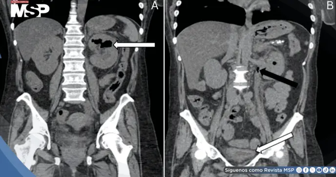 Pielitis enfisematosa fulminante en paciente diabética: Diagnóstico y resolución tras drenaje percutáneo Pielitis enfisematosa fulminante en paciente diabética: Diagnóstico y resolución tras drenaje percutáneo