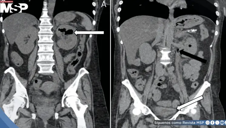 Pielitis enfisematosa fulminante en paciente diabética: Diagnóstico y resolución tras drenaje percutáneo