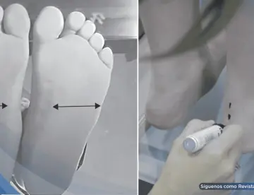 La obesidad infantil aumenta hasta un 40% la presión sobre el pie y podría alterar el desarrollo motor