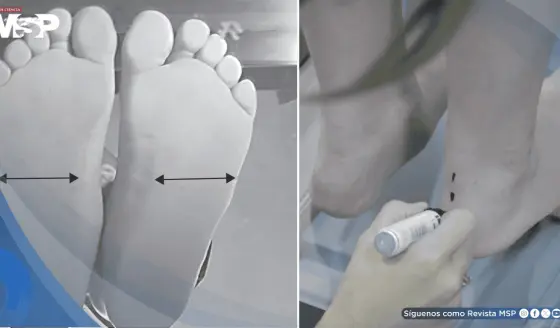 La obesidad infantil aumenta hasta un 40% la presión sobre el pie y podría alterar el desarrollo motor