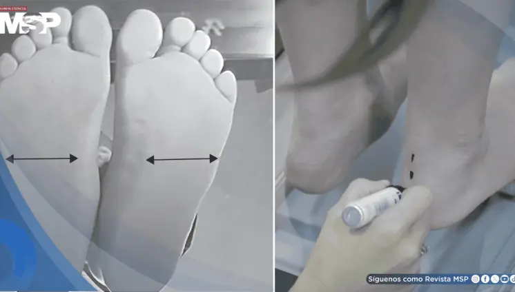 La obesidad infantil aumenta hasta un 40% la presión sobre el pie y podría alterar el desarrollo motor