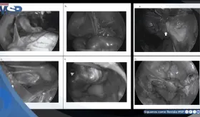 Detectan tuberculosis genital en mujer con útero desviado y los ovarios destruidos