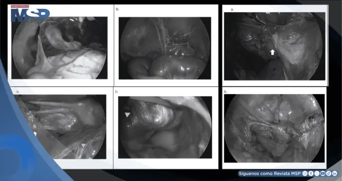 Detectan tuberculosis genital en mujer con útero desviado y los ovarios destruidos 