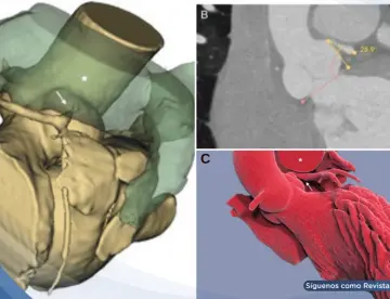 Isquemia por compresión de la arteria coronaria izquierda en paciente con hipertensión pulmonar