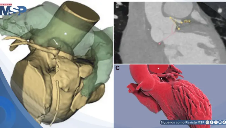 Isquemia por compresión de la arteria coronaria izquierda en paciente con hipertensión pulmonar