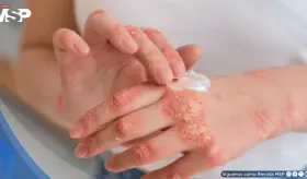 Nuevos tratamientos biológicos para la psoriasis logran 90% de efectividad y previenen daños articulares