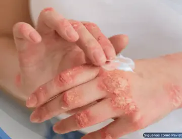Nuevos tratamientos biológicos para la psoriasis logran 90% de efectividad y previenen daños articulares