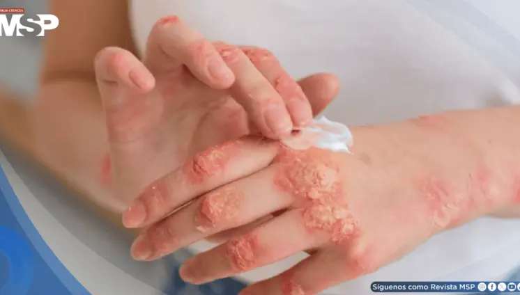 Nuevos tratamientos biológicos para la psoriasis logran 90% de efectividad y previenen daños articulares