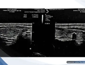 Madre e hija desarrollaron tiroiditis de Hashimoto tras vacunación y contagio por COVID-19