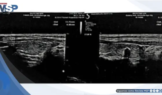 Madre e hija desarrollaron tiroiditis de Hashimoto tras vacunación y contagio por COVID-19