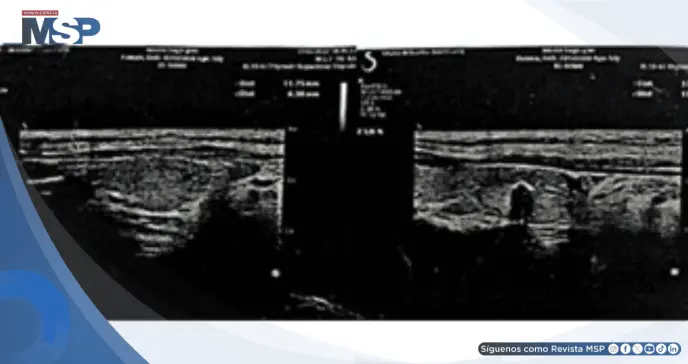 Madre e hija desarrollaron tiroiditis de Hashimoto tras vacunación y contagio por COVID-19 Madre e hija desarrollaron tiroiditis de Hashimoto tras vacunación y contagio por COVID-19