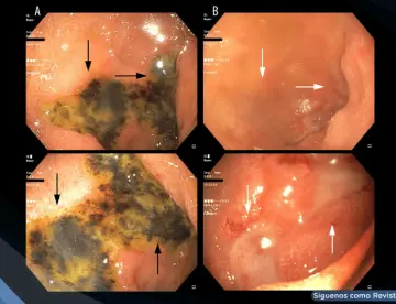Describen caso de fallo multiorgánico asociado a sobredosis intencional de semaglutida
