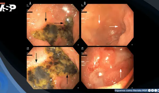 Describen caso de fallo multiorgánico asociado a sobredosis intencional de semaglutida