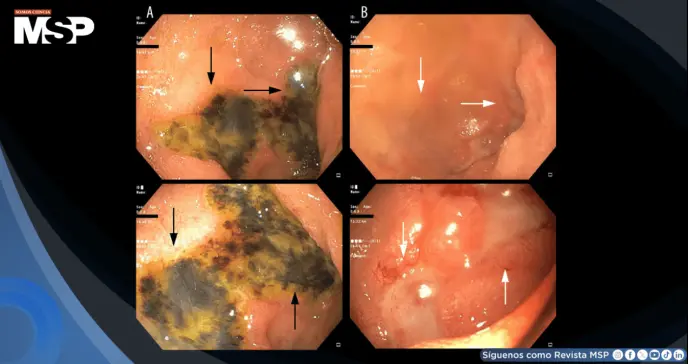 Describen caso de fallo multiorgánico asociado a sobredosis intencional de semaglutida Describen caso de fallo multiorgánico asociado a sobredosis intencional de semaglutida