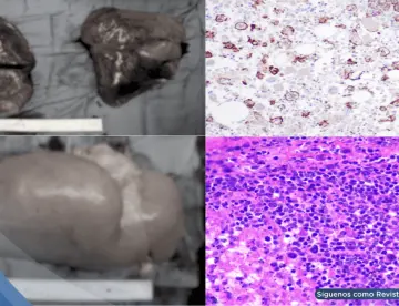 Hombre con diabetes e hipertensión muere por reacción inmunológica tras infección por Salmonella Typhi