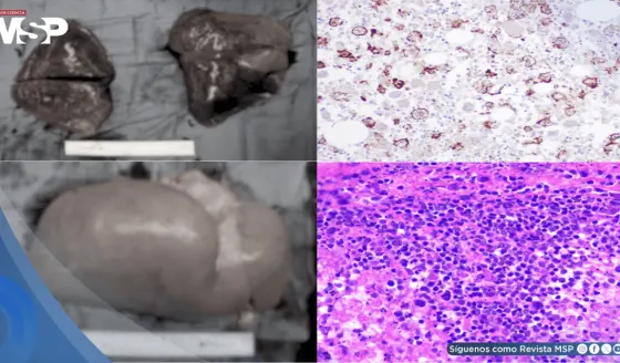 Hombre con diabetes e hipertensión muere por reacción inmunológica tras infección por Salmonella Typhi