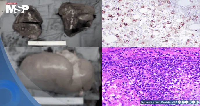 Hombre con diabetes e hipertensión muere por reacción inmunológica tras infección por Salmonella Typhi Hombre con diabetes e hipertensión muere por reacción inmunológica tras infección por Salmonella Typhi