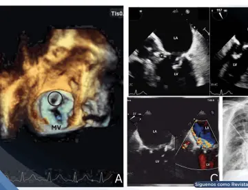 Endocarditis de Staphylococcus epidermidis tras implante de marcapasos causa pseudoaneurisma mitroaórtico