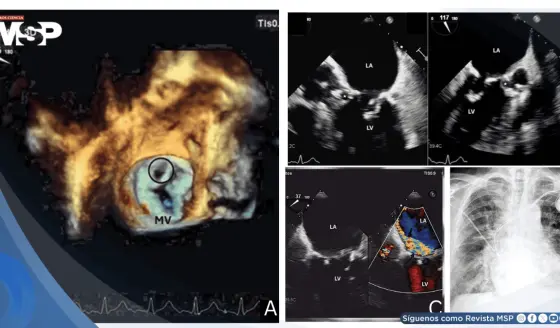 Endocarditis de Staphylococcus epidermidis tras implante de marcapasos causa pseudoaneurisma mitroaórtico