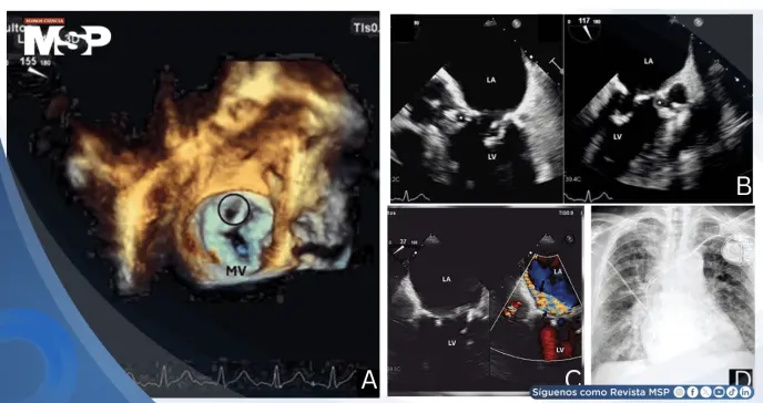 Endocarditis de Staphylococcus epidermidis tras implante de marcapasos causa pseudoaneurisma mitroaórtico Endocarditis de Staphylococcus epidermidis tras implante de marcapasos causa pseudoaneurisma mitroaórtico