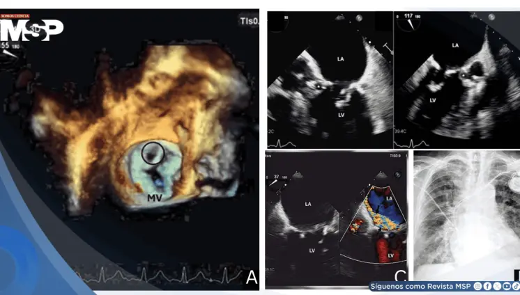 Endocarditis de Staphylococcus epidermidis tras implante de marcapasos causa pseudoaneurisma mitroaórtico