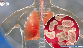 Tos convulsa: Cómo reconocer la enfermedad y prevenirla ante el aumento de incidencia