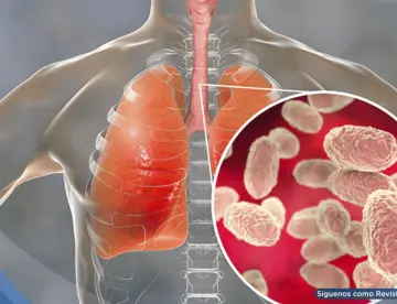 Tos convulsa: Cómo reconocer la enfermedad y prevenirla ante el aumento de incidencia 