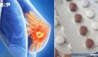 Algunos anticonceptivos hormonales podrían aumentar el riesgo de cáncer de mama: Estudio
