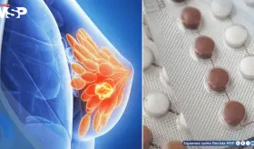 Algunos anticonceptivos hormonales podrían aumentar el riesgo de cáncer de mama: Estudio