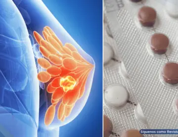 Algunos anticonceptivos hormonales podrían aumentar el riesgo de cáncer de mama: Estudio