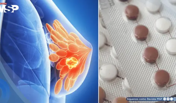Algunos anticonceptivos hormonales podrían aumentar el riesgo de cáncer de mama: Estudio