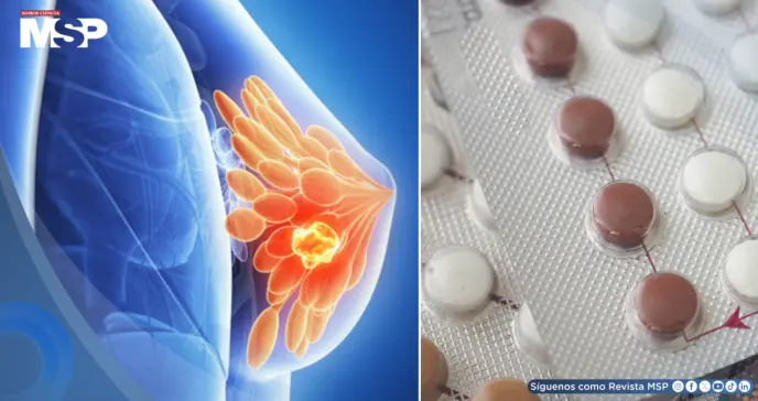 Algunos anticonceptivos hormonales podrían aumentar el riesgo de cáncer de mama: Estudio