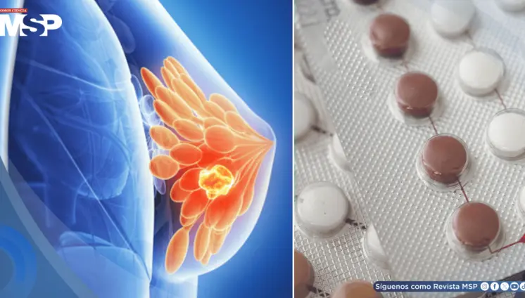 Algunos anticonceptivos hormonales podrían aumentar el riesgo de cáncer de mama: Estudio
