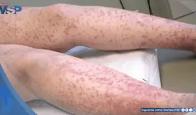 Hebra de Fibrina: Crónica de una coagulación intravascular diseminada en sepsis