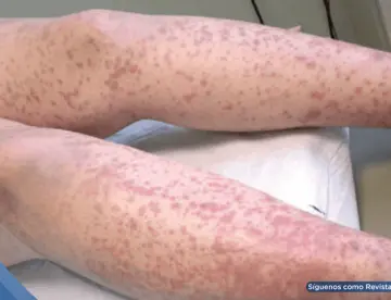 Hebra de Fibrina: Crónica de una coagulación intravascular diseminada en sepsis