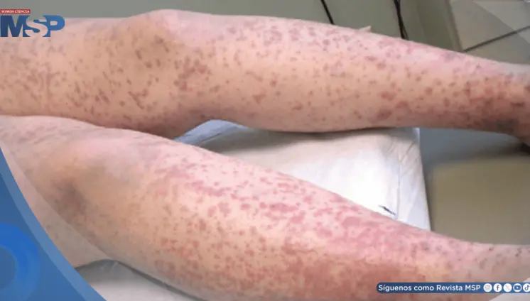 Hebra de Fibrina: Crónica de una coagulación intravascular diseminada en sepsis