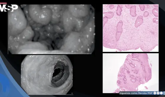 Detectan síndrome de Cronkhite-Canada en hombre con pérdida de peso tras diagnóstico erróneo de Crohn
