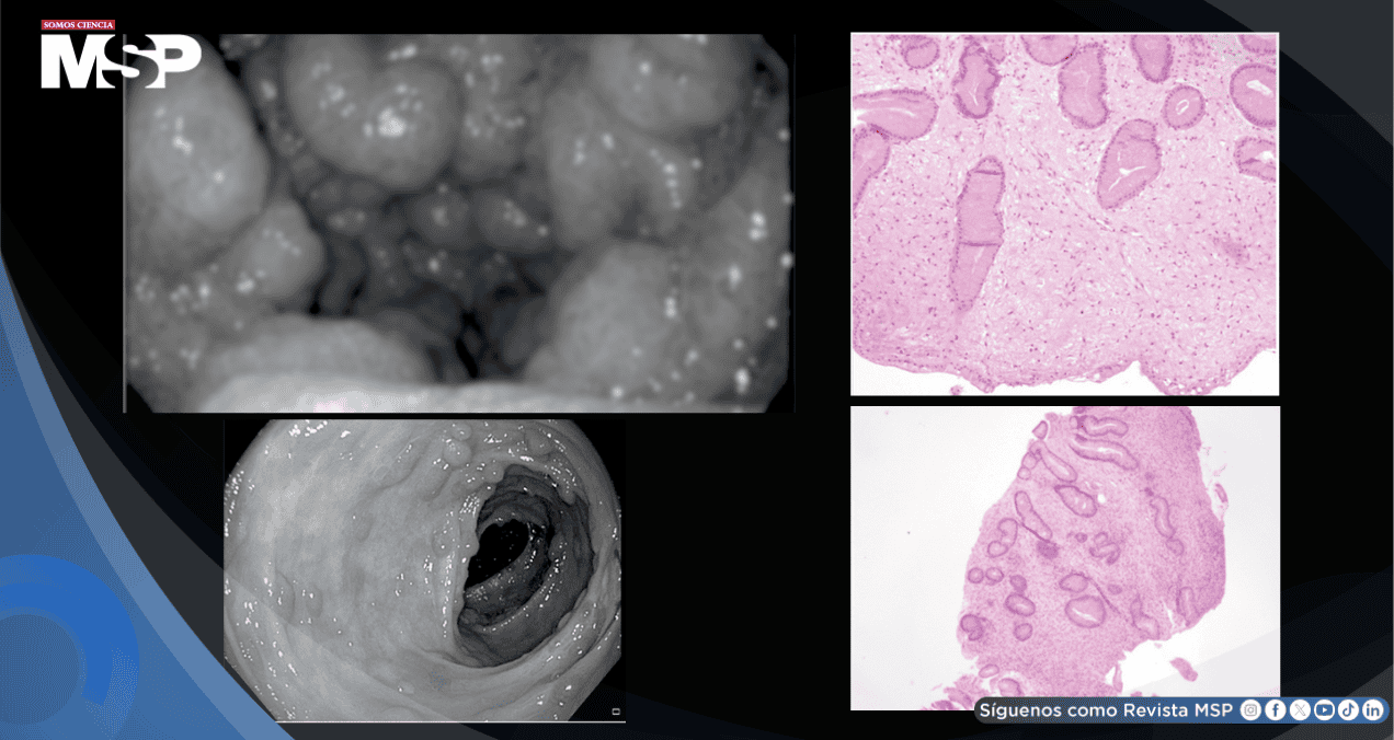 Detectan síndrome de Cronkhite-Canada en hombre con pérdida de peso tras diagnóstico erróneo de Crohn