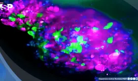 Así se detecta el cáncer en estadio 0: Ofrece supervivencia del 99 % si se diagnostica a tiempo