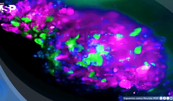 Así se detecta el cáncer en estadio 0: Ofrece supervivencia del 99 % si se diagnostica a tiempo