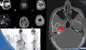 Neuroborreliosis de Lyme transmitida por garrapatas en mujer con parálisis facial y encefalopatía