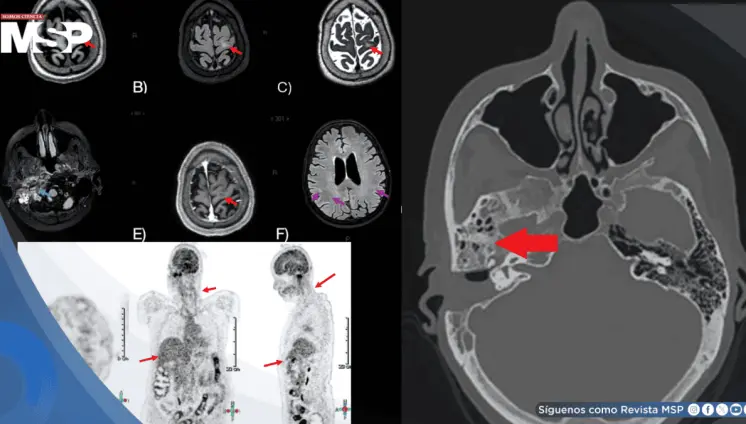 Neuroborreliosis de Lyme transmitida por garrapatas en mujer con parálisis facial y encefalopatía