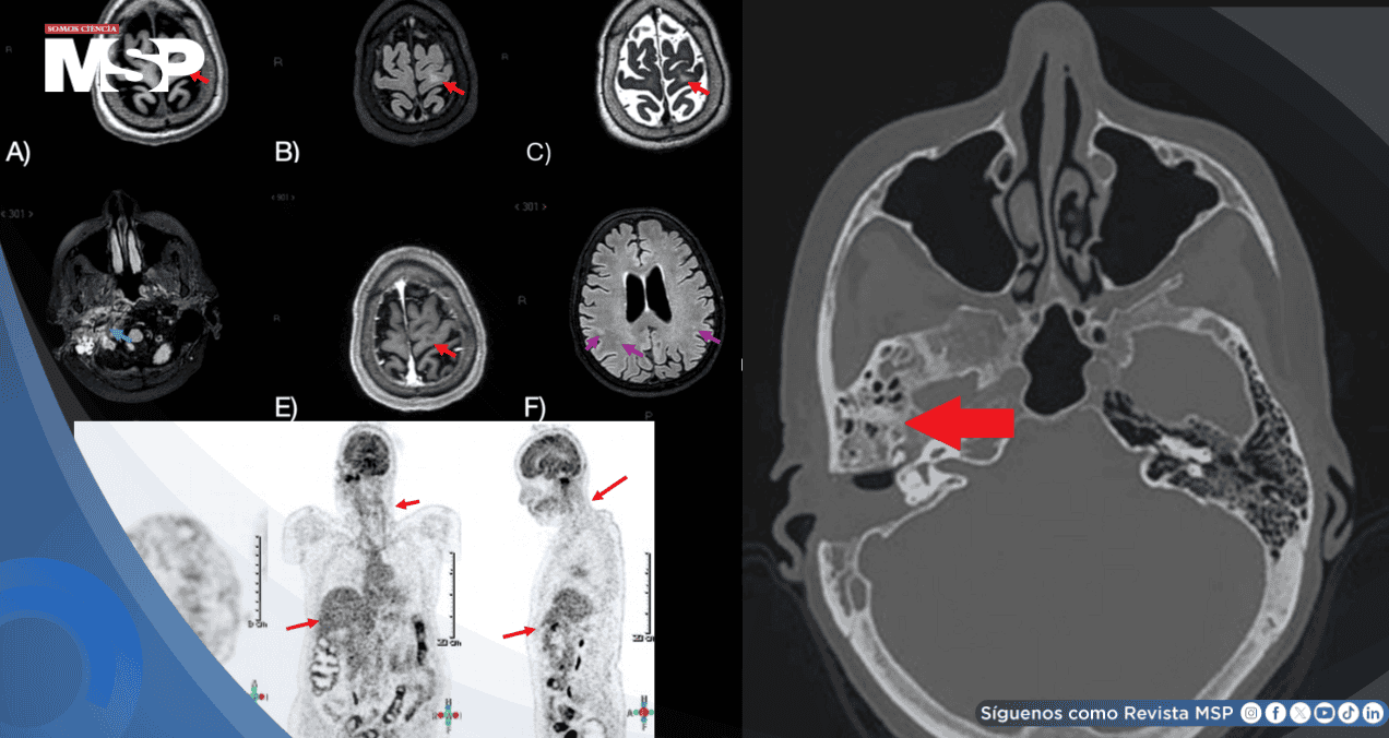Neuroborreliosis de Lyme transmitida por garrapatas en mujer con parálisis facial y encefalopatía Neuroborreliosis de Lyme transmitida por garrapatas en mujer con parálisis facial y encefalopatía