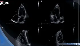 Neumonía por Mycoplasma y aleteo auricular desencadenan trombos biventriculares en paciente joven 