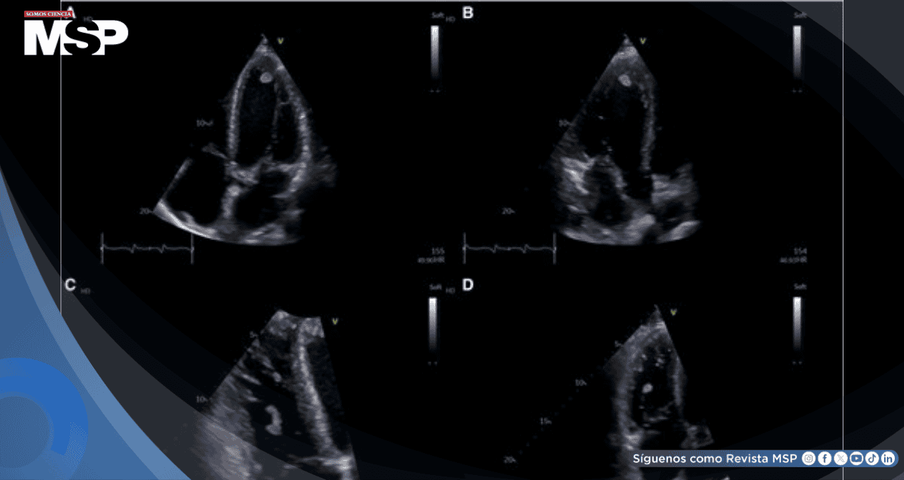 Neumonía por Mycoplasma y aleteo auricular desencadenan trombos biventriculares en paciente joven 