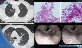 Candidiasis esofágica en hombre con asma tras automedicarse con fluticasona y tragar enjuague bucal