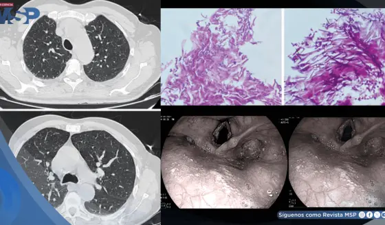 Candidiasis esofágica en hombre con asma tras automedicarse con fluticasona y tragar enjuague bucal