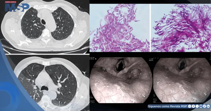 Candidiasis esofágica en hombre con asma tras automedicarse con fluticasona y tragar enjuague bucal