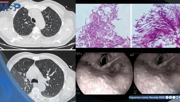 Candidiasis esofágica en hombre con asma tras automedicarse con fluticasona y tragar enjuague bucal